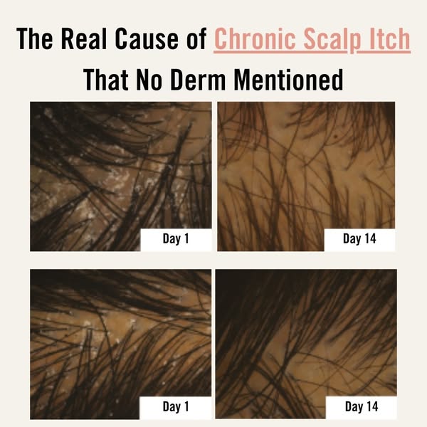 UpCircle ad: Not Dandruff? It’s Inflammation 😱