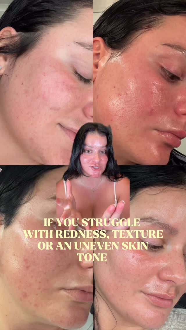 The Ordinary ad: #ad azelaic acid is having a MOMENT and it could literally be the answer to your skin problems 🤭 my personal favorite (especially for begin