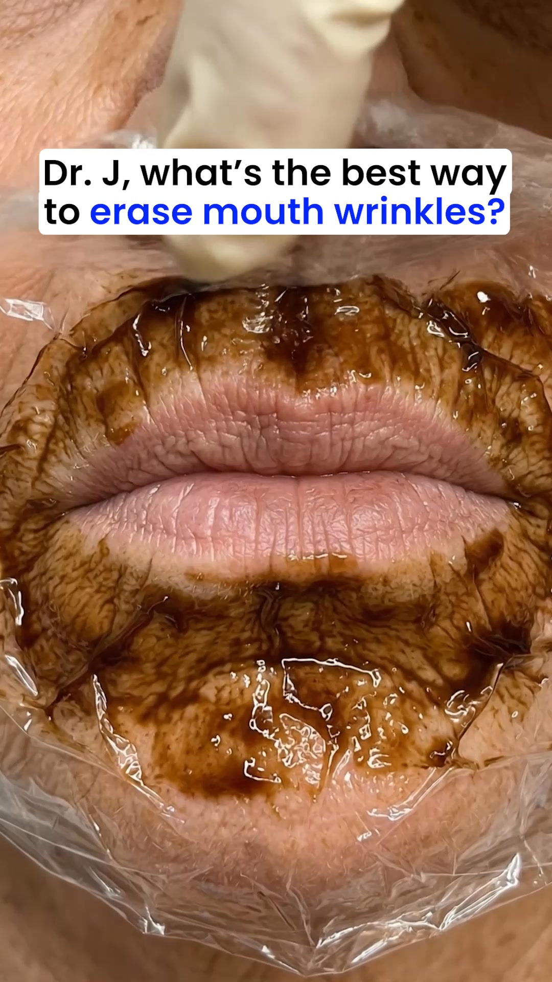 Miami MD ad: The best way to help erase wrinkles at home