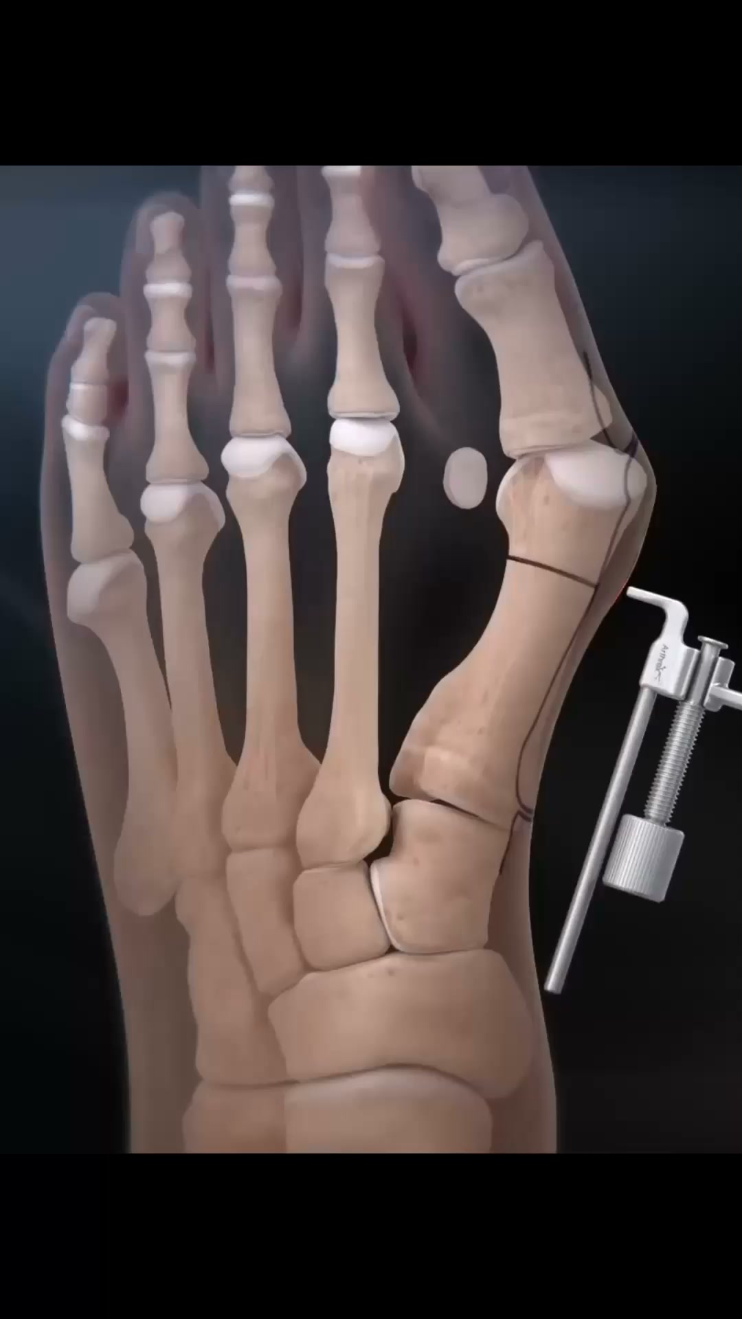 OrthoFlexx ad: Arch Support That Doesn't Collapse