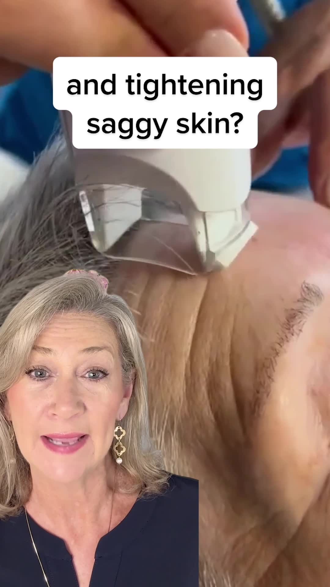 Miami MD ad: The best way to erase mouth wrinkles?