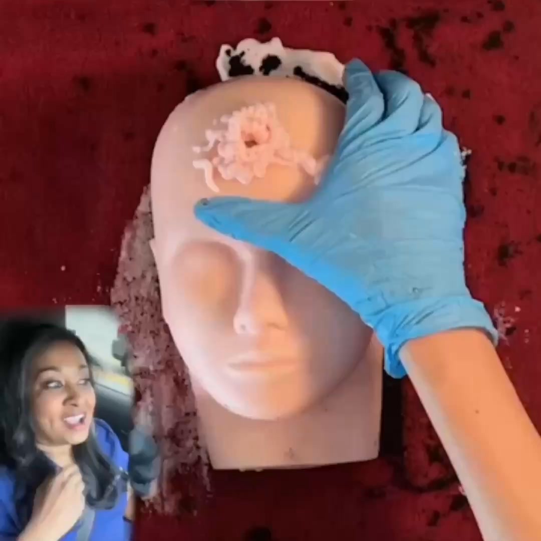 Miami MD ad: How to help erase mouth wrinkles