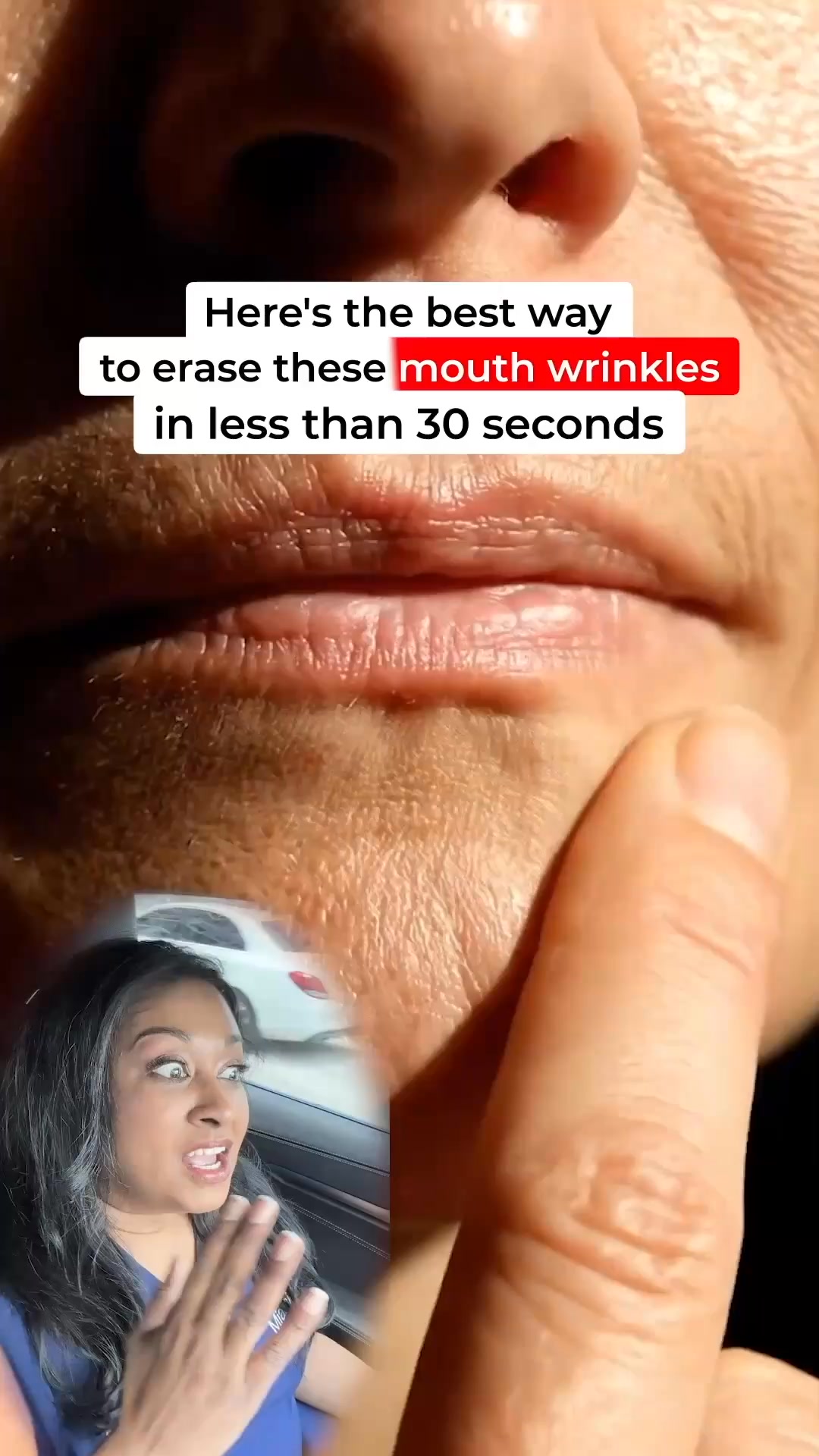 Miami MD ad: The best way to erase mouth wrinkles?