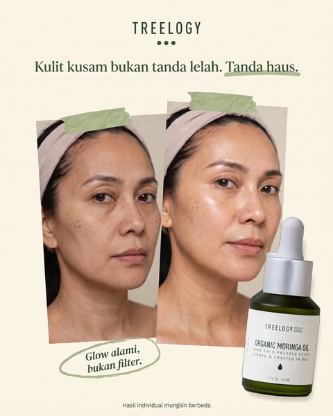 Treelogy ad: Masih jerawatan di usia 43?