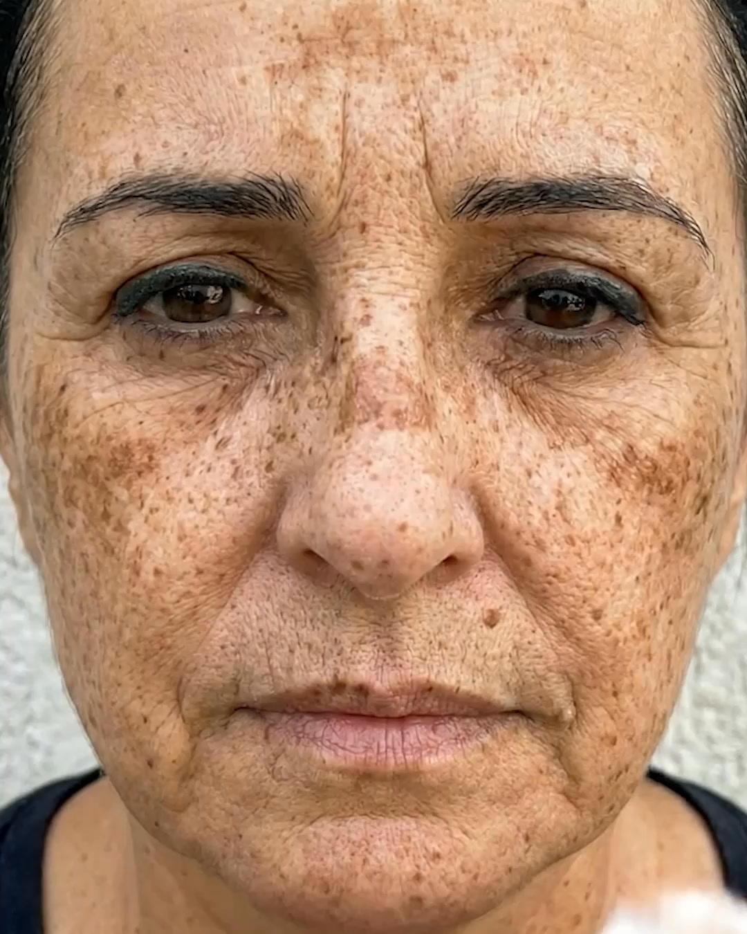 Miami MD ad: Stop Covering Your Dark Spots With Makeup, Do This Instead