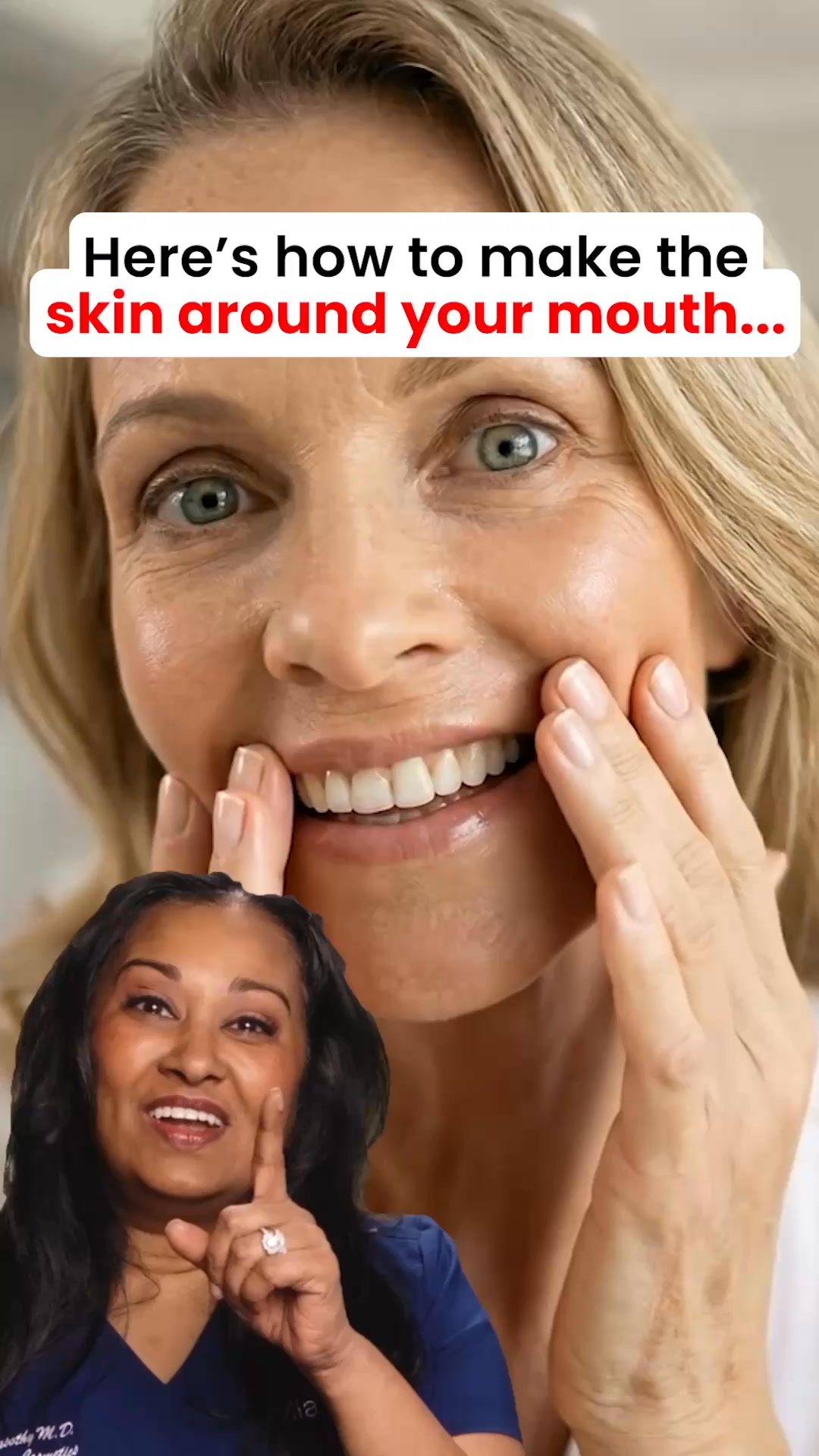 Miami MD ad: The best way to erase mouth wrinkles?